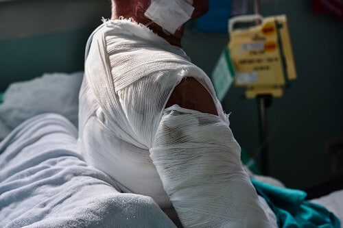 man with a catastrophic injury of severe burns sits in a hospital bed