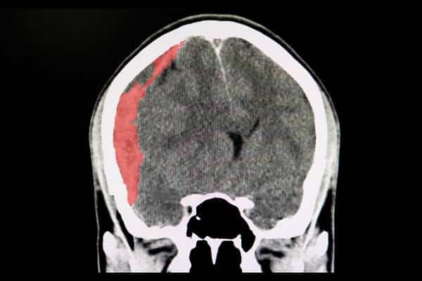a scan showing a closed head traumatic brain injury