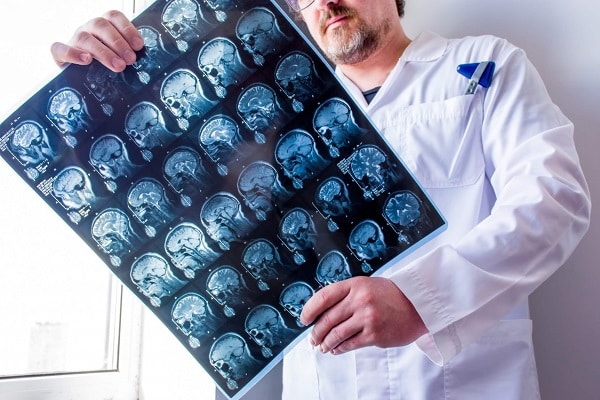 doctor interpreting a scan of a traumatic brain injury