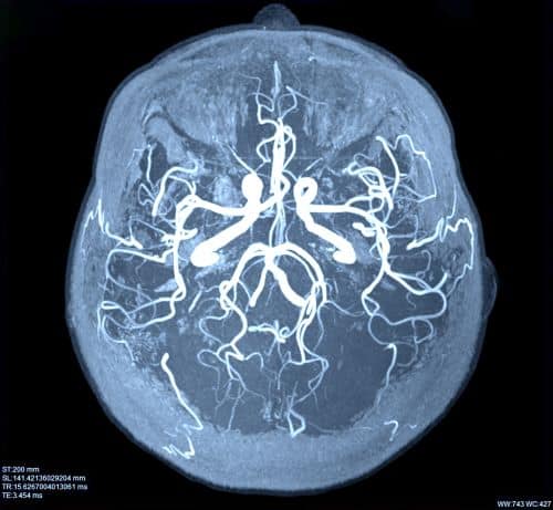 A brain image after an anoxic injury.