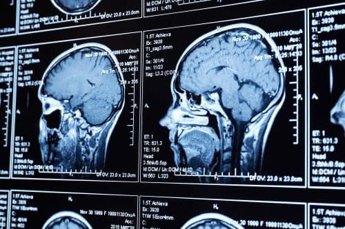 A closeup of an MRI scan of a brain after an injury.