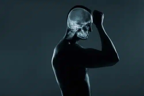 X Ray scan showing Traumatic Brain Injury